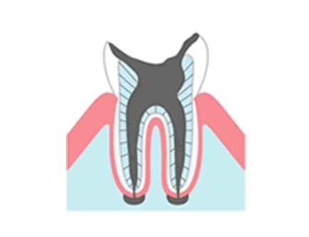 歯根だけ残ったむし歯（C4）