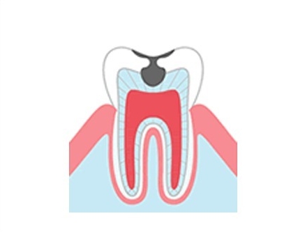 象牙質まで進んだむし歯（C2）