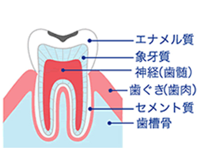 エナメル質のむし歯（C1）